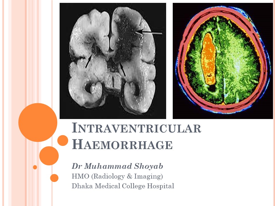 Imaging of Ventricular Haemorrhage